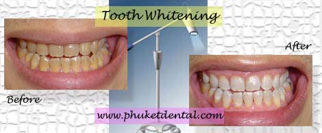 Tetracycline tooth whitening